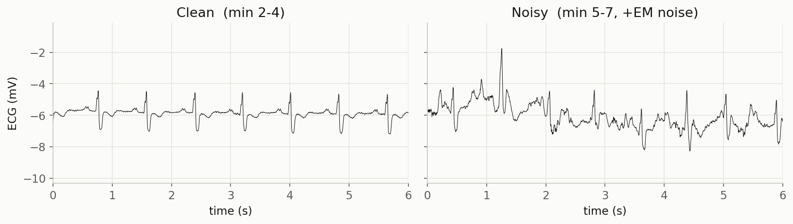 A clean ECG segment with sharp beats next to a noisy segment where the baseline is full of interference